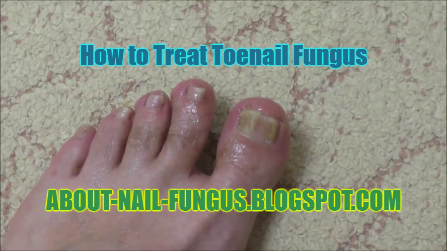 How to Treat Toenail Fungus