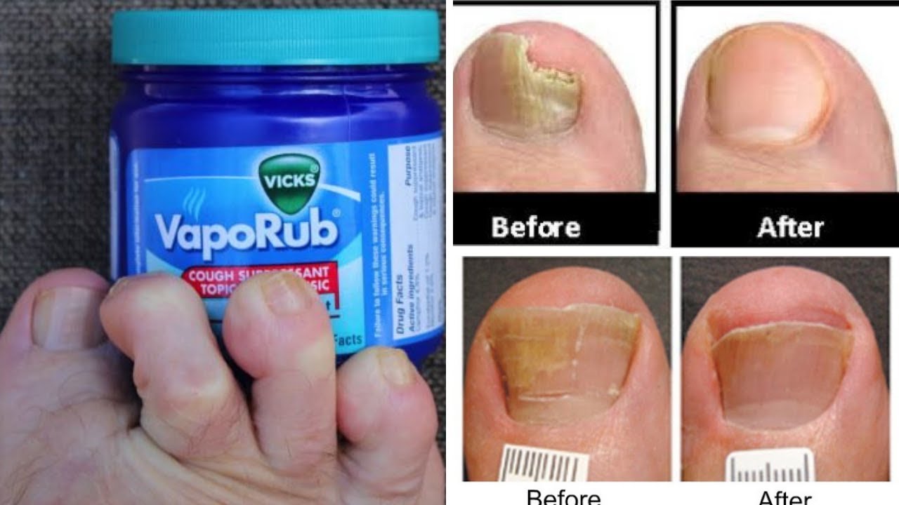 How to treat toenail fungus at home