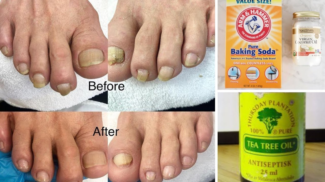 How to treat toenail fungus
