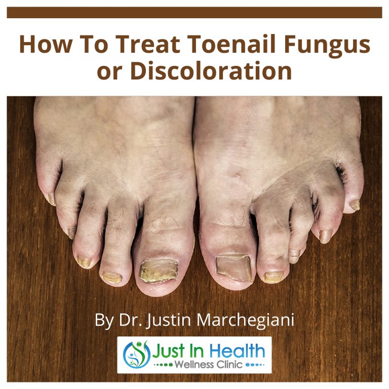 How To Treat Toenail Fungus or Discoloration