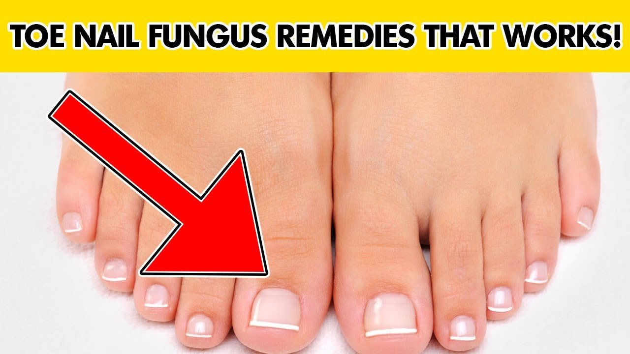 How to treat toenail fungus very fast