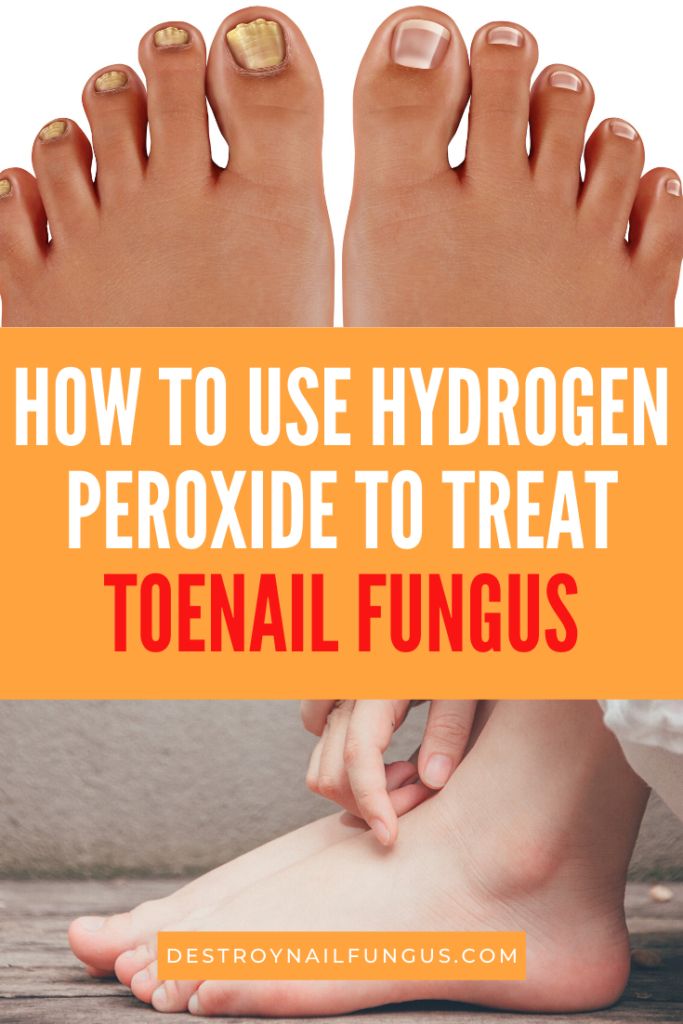 How To Treat Toenail Fungus With Hydrogen Peroxide ...