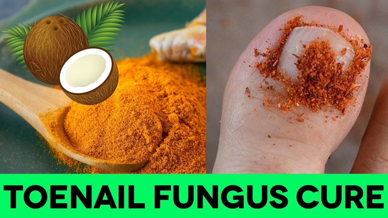 How To Treat Toenail Fungus With Turmeric &  Coconut Oil ...