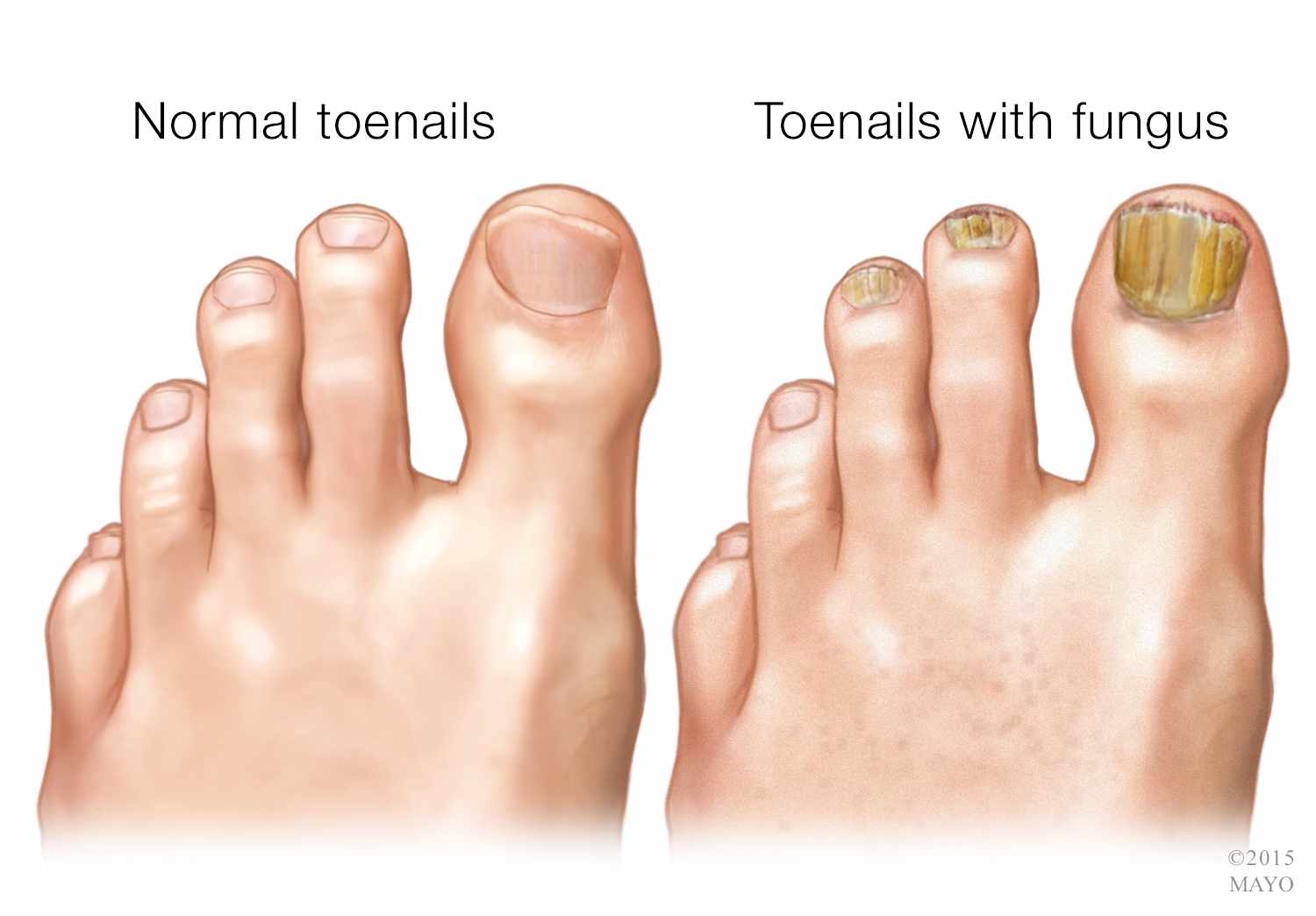 How to treat toenail fungus with vicks