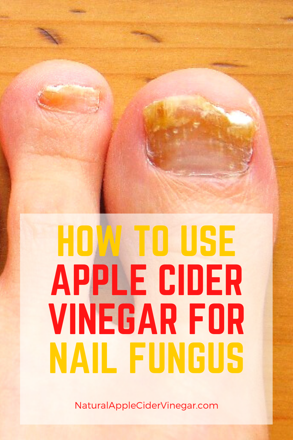 How to Use Apple Cider Vinegar for Nail Fungus