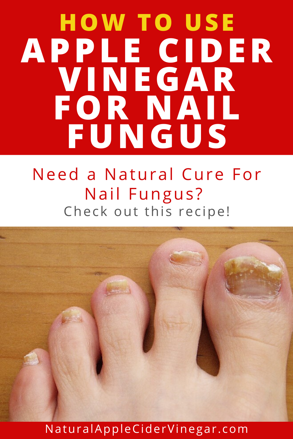 How to Use Apple Cider Vinegar for Nail Fungus