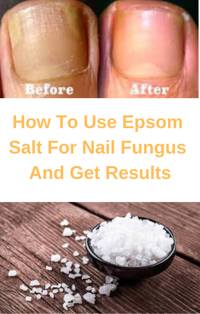 How To Use Epsom Salt For Nail Fungus And Get Results