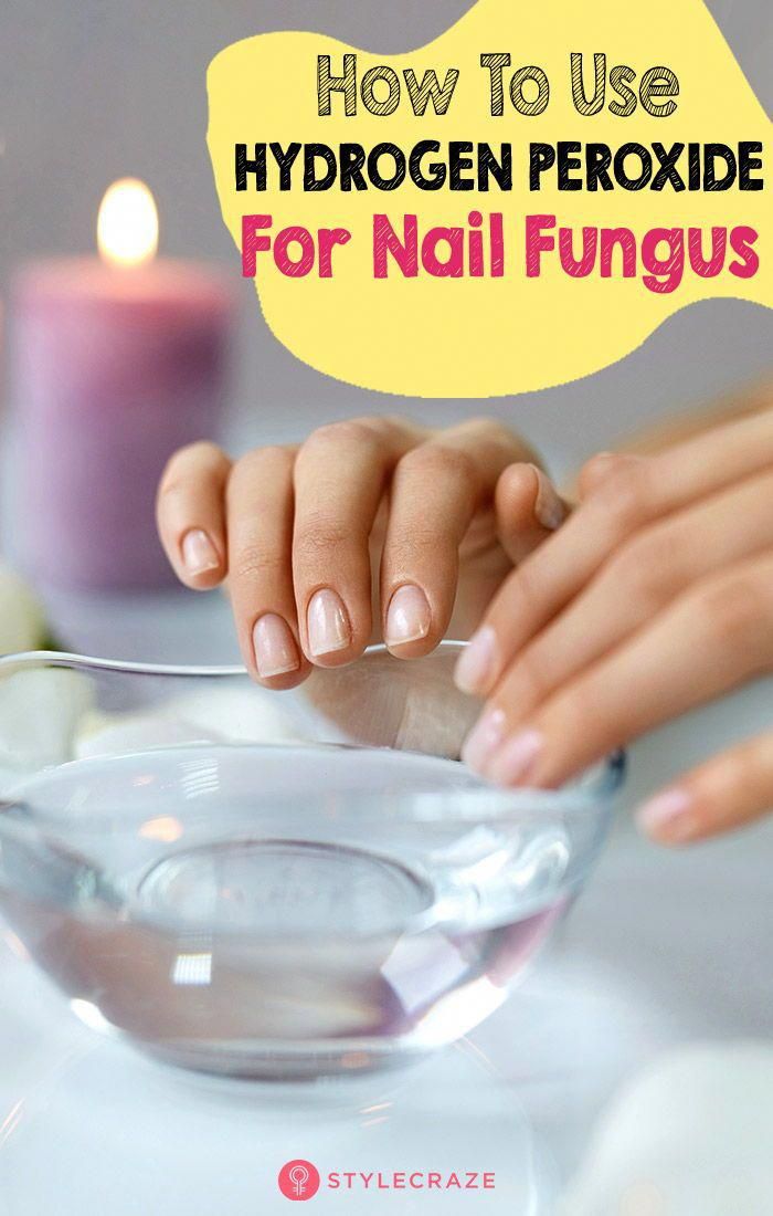 How To Use Hydrogen Peroxide For Nail Fungus â A Step By ...