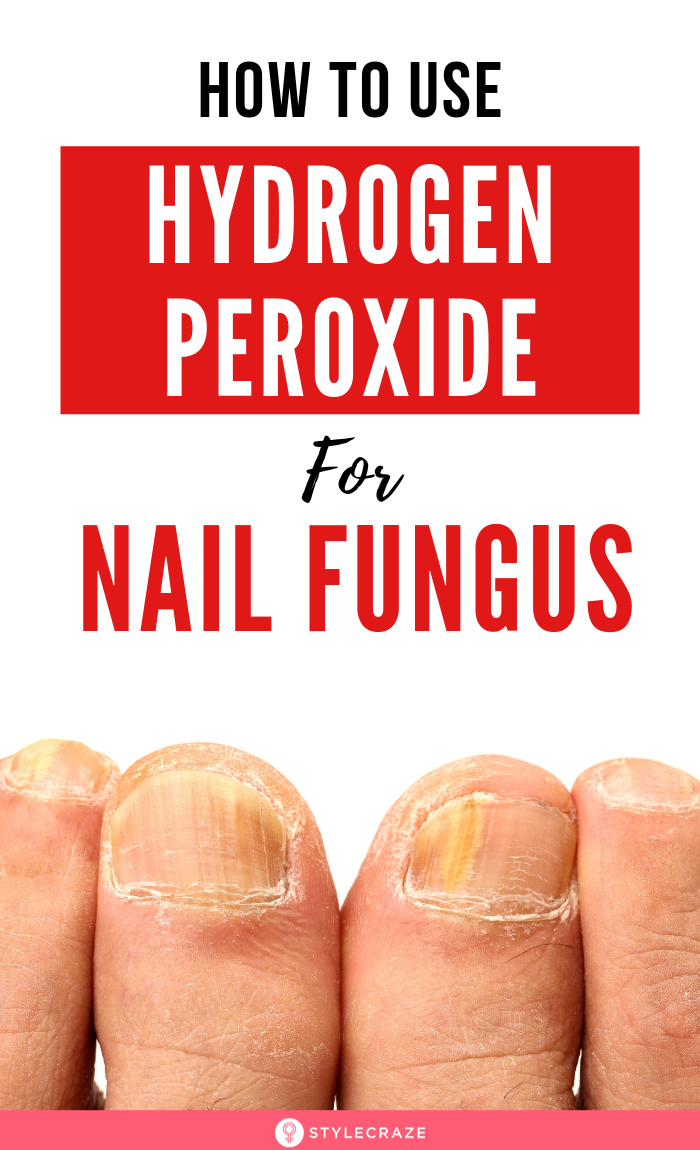 How To Use Hydrogen Peroxide For Nail Fungus  A Step By Step Guide ...