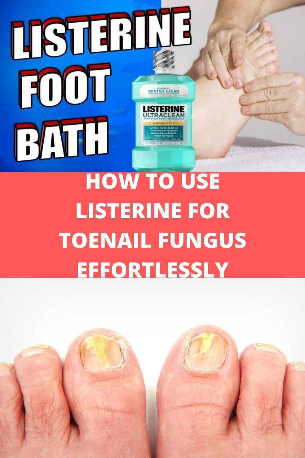 HOW TO USE LISTERINE FOR TOENAIL FUNGUS EFFORTLESSLY ...