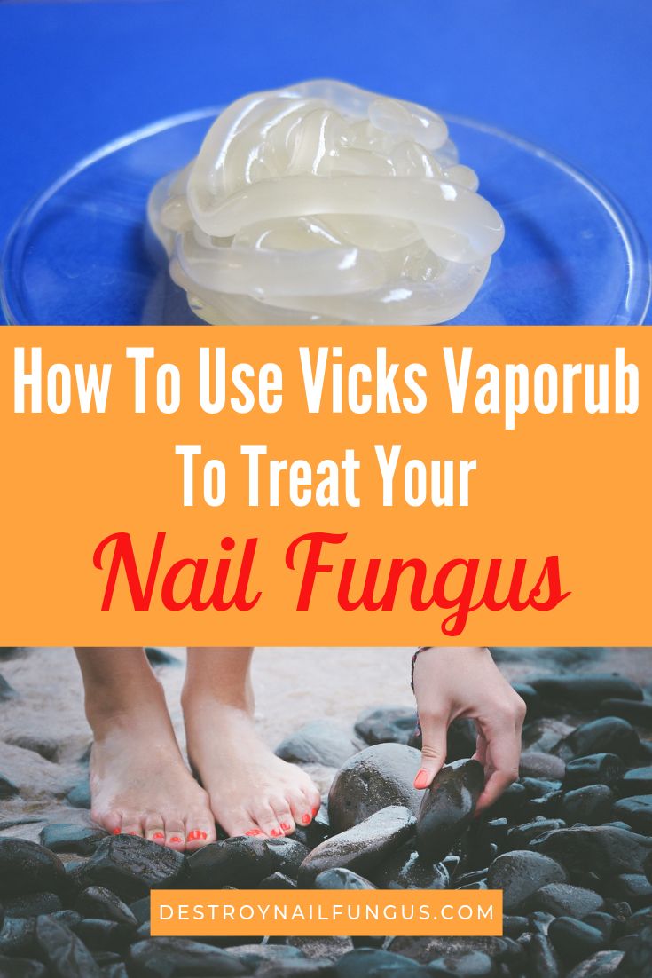 How To Use Vicks Vaporub To Treat Your Nail Fungus