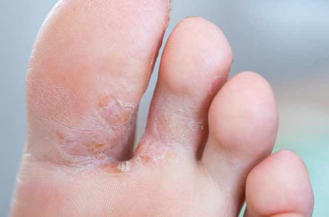 How You Can Stop Foot and Toenail Fungus In Its Tracks ...