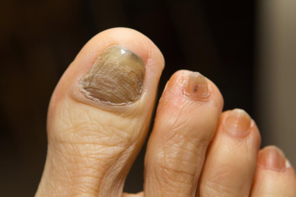 How You Can Use Baking Soda To Fight Toenail Fungus (Now!)