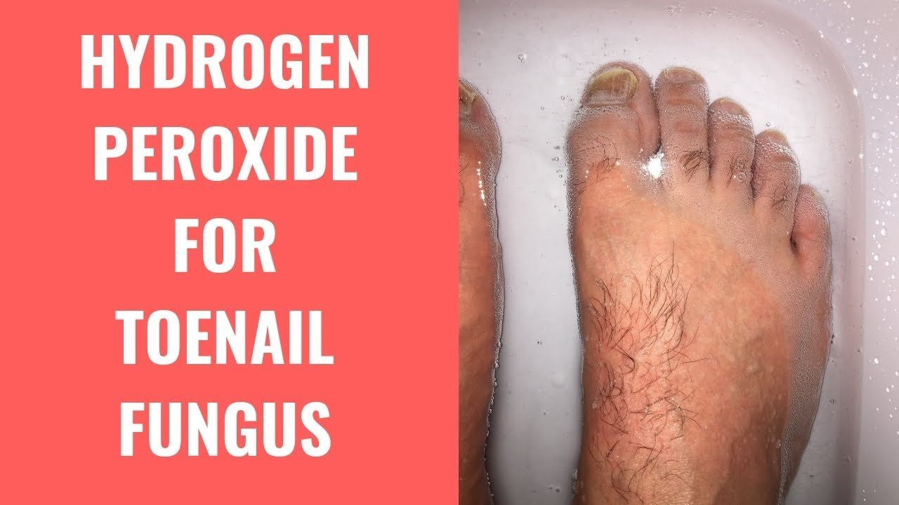 Hydrogen Peroxide Effective For Treating Toenail Fungus ...