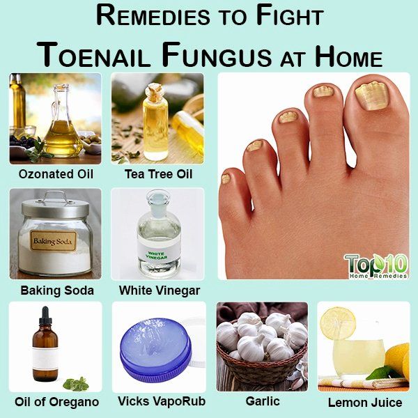 Hydrogen Peroxide for Nail Fungus Lovely How to White toenails Mix A ...