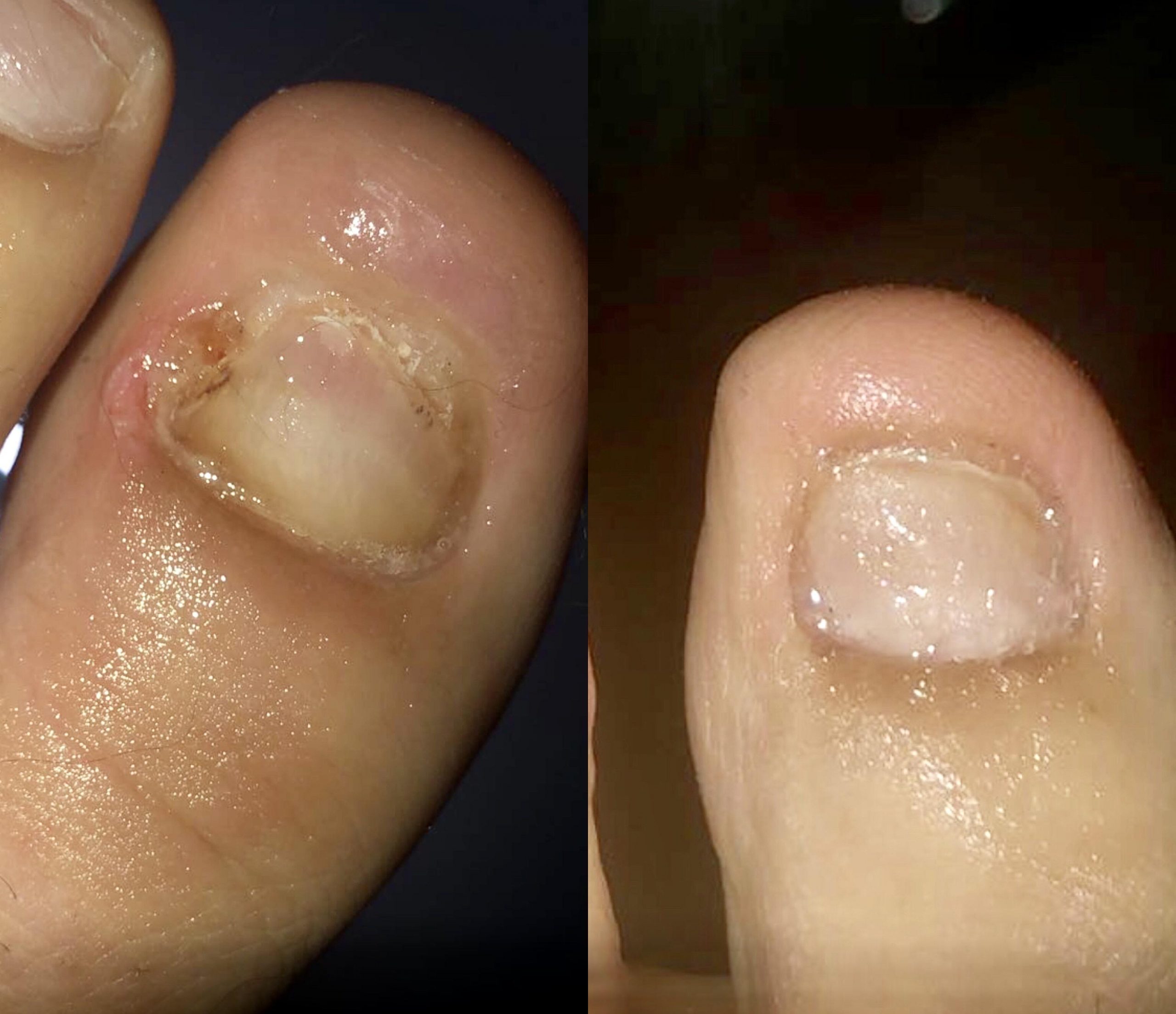 Hydrogen Peroxide Toenail Fungus Before And After