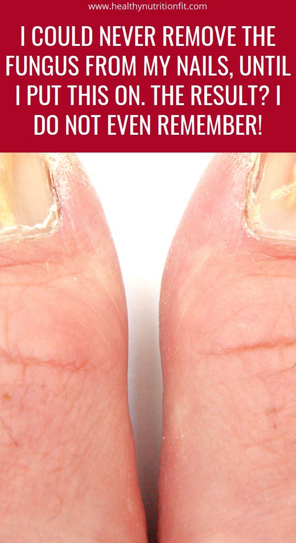 I Could Never Remove The Fungus From My Nails, Until I Put ...