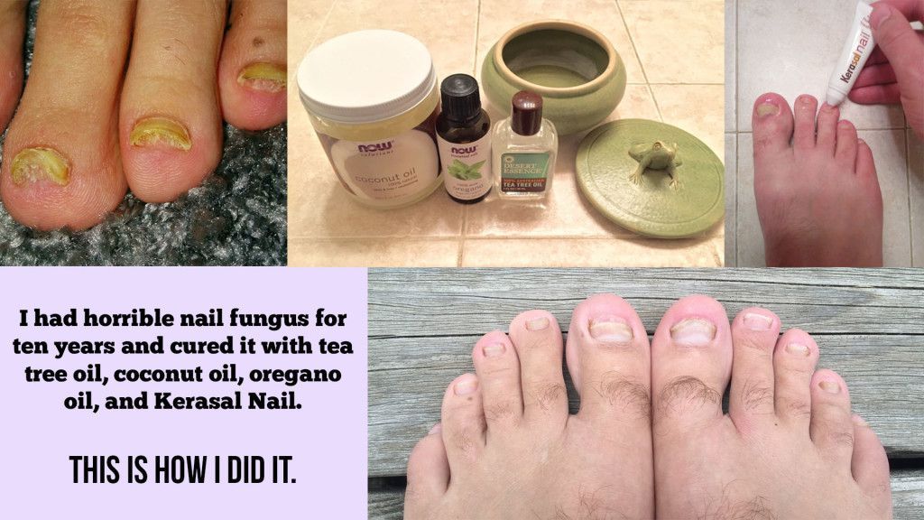 I had horrible nail fungus for ten years and cured it with ...