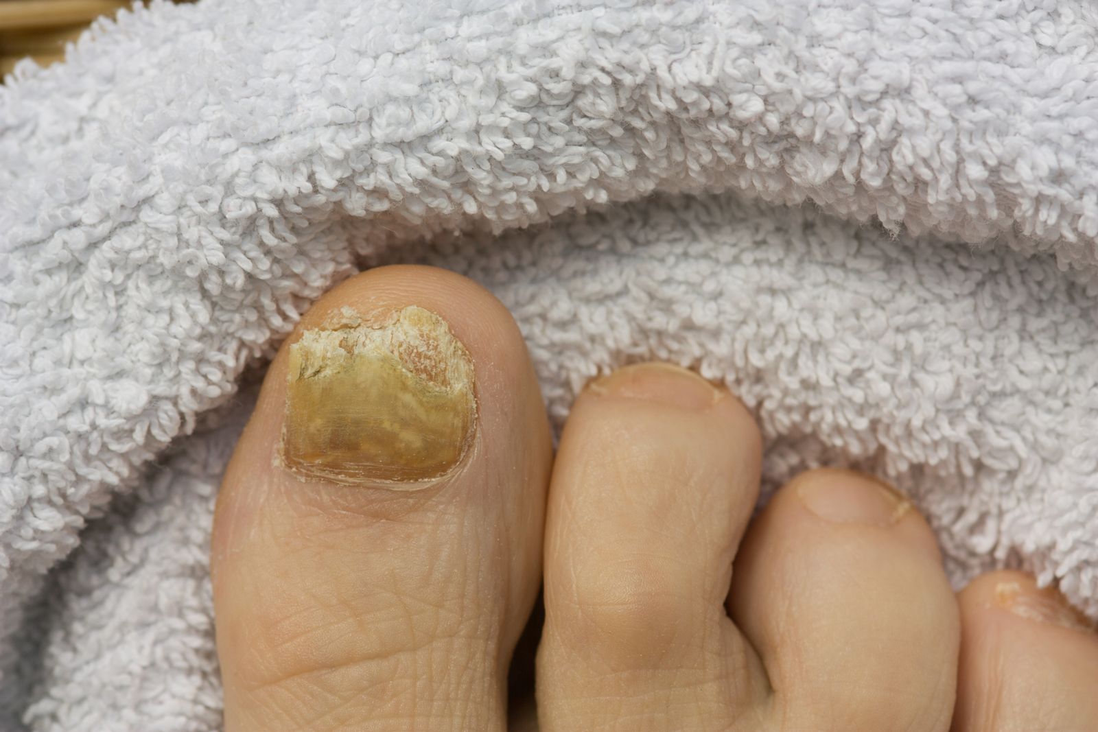 If I get my toenail removed, will the fungal nail grow ...