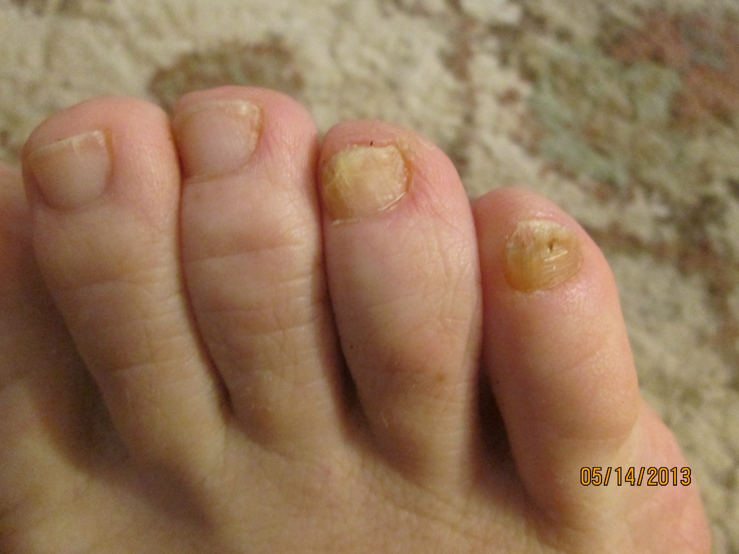 Images of toenail fungus