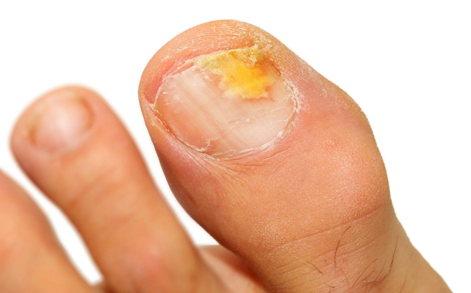 Ingrown Toe Nails, Foot Fungus, and Nail Trimming
