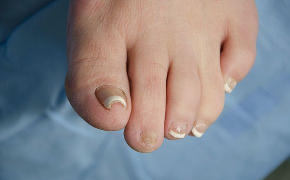ingrown toenail &  Laser toenail fungus treatment by Advanced ...