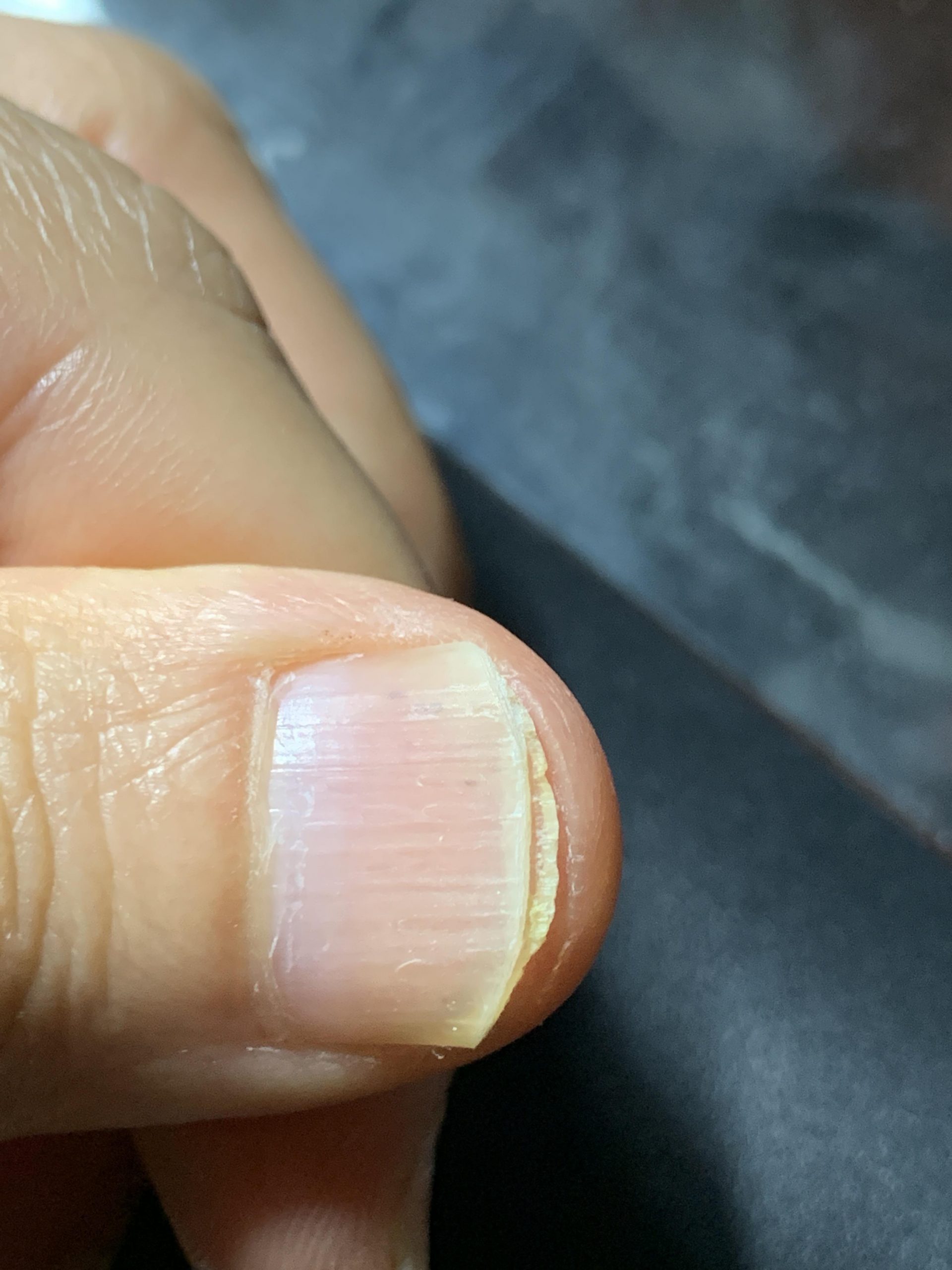 Is this nail fungus? : NailFungus