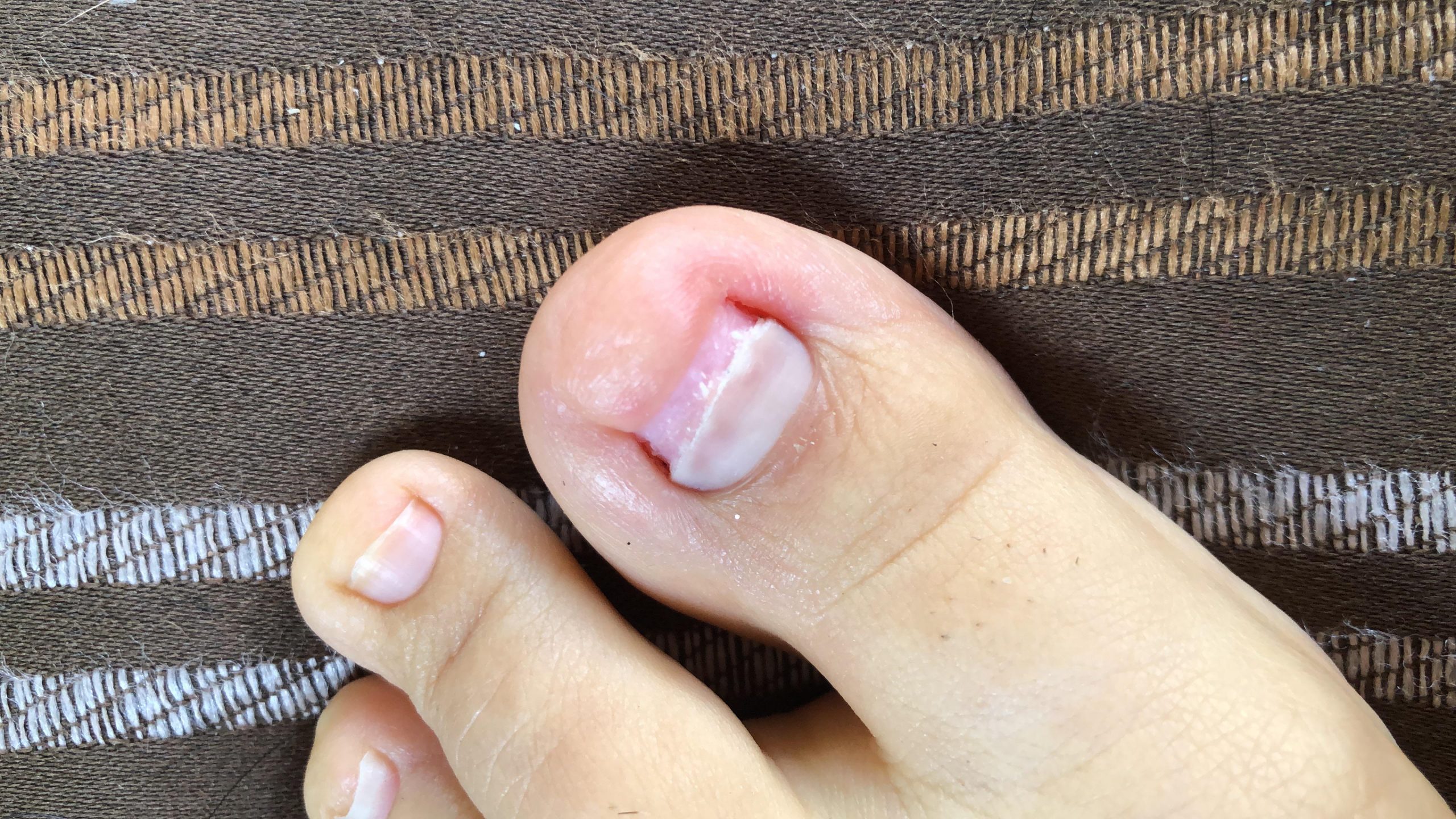 Is this toenail fungus? Every time I let my nail grow out ...