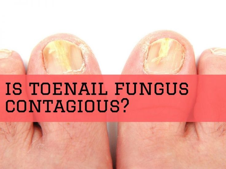 Is toenail fungus contagious?
