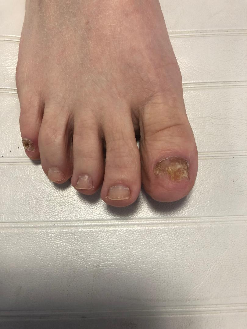 Is toenail fungus painful? Why you should not ignore it ...