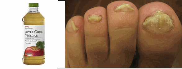 Is Vinegar Good For Fungus Nails