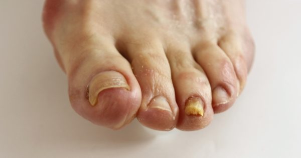 Kerasal For Toenail Fungus: Benefits &  Side Effects! Find ...