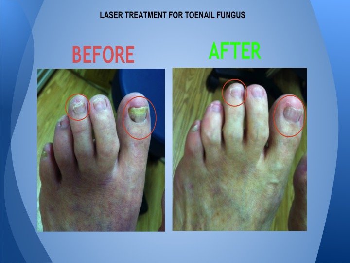 Laser For Nail Fungus Does It Work