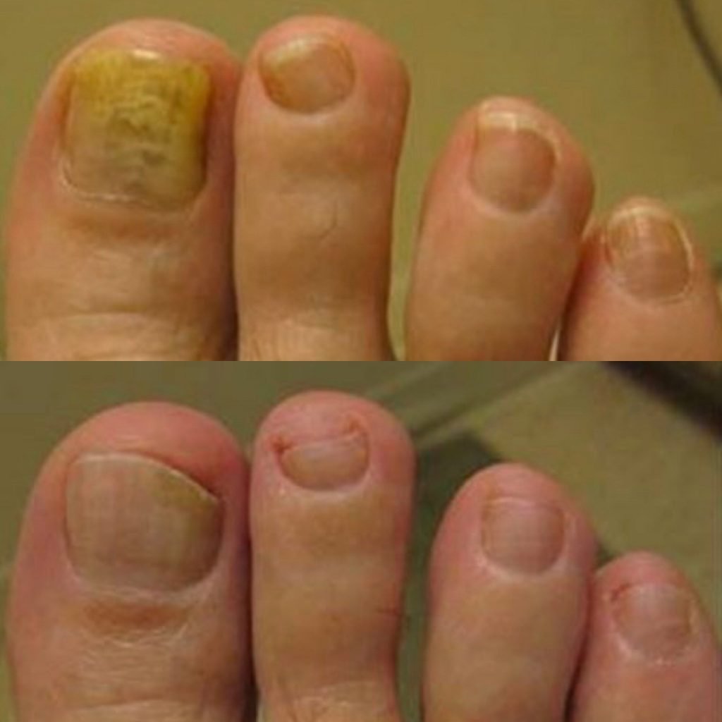 Laser Fungal Nail Removal
