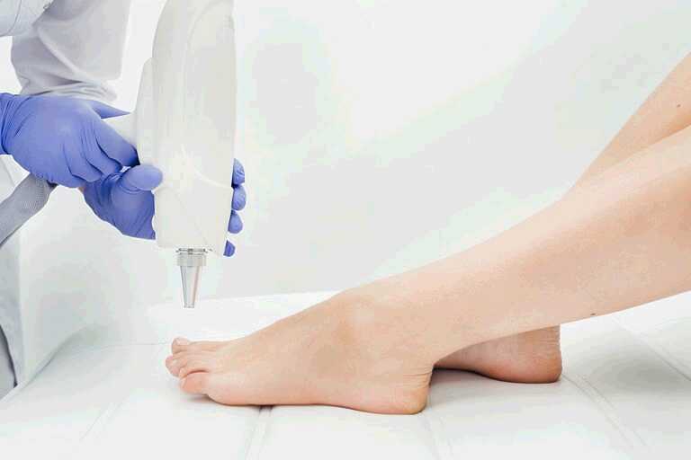 Laser Toenail Fungus removal, Does it work?