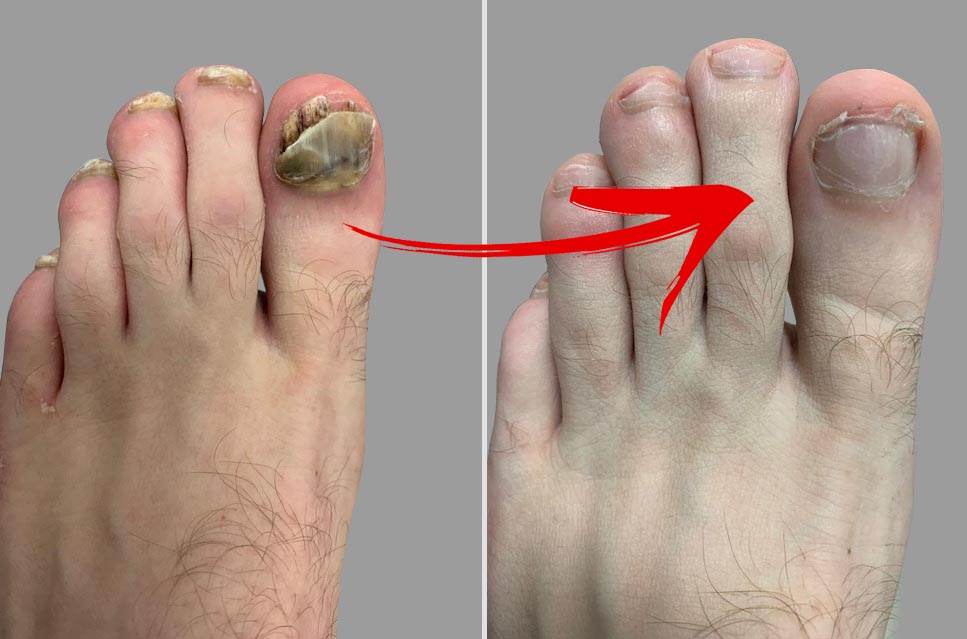 Laser Toenail fungus Removal Treatment At Home  Does it ...