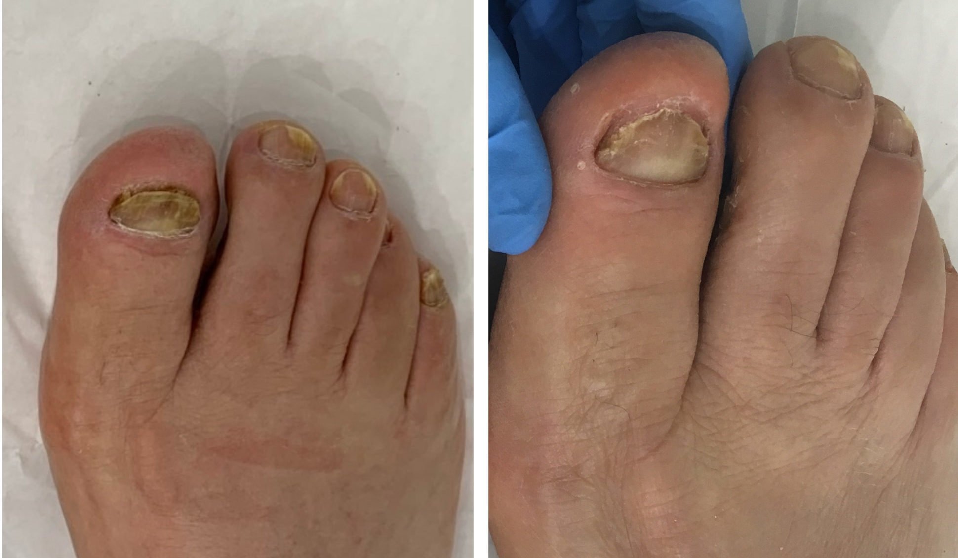 Laser Toenail Fungus Removal: What It Is and How It Works ...