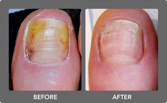 Laser Treatment For Toenail Fungus Covered By Insurance ...