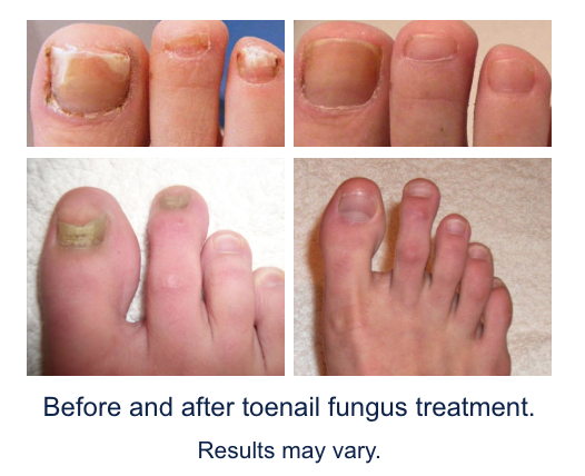 Laser Treatment For Toenail Fungus Covered By Insurance ...
