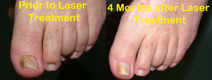 Laser Treatment for toenail fungus