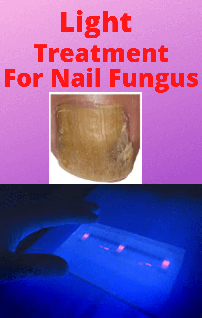 Light Treatment For Nail Fungus (Does It Work)
