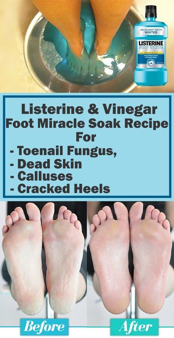 Listerine &  Vinegar Foot Miracle Soak Recipe for Toenail Fungus, Dead ...