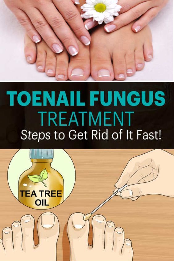 Looking at sickening toenail fungus  yours or a companion ...