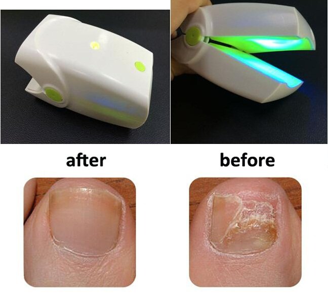 Nail Cleaning Laser Device Nail Fungus Treatment With 465 ...