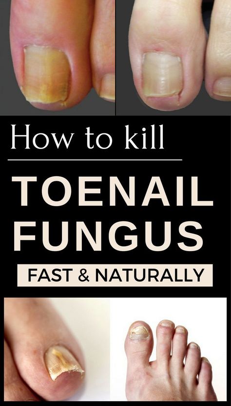Nail fungal infections are caused by tiny microscopic organisms called ...