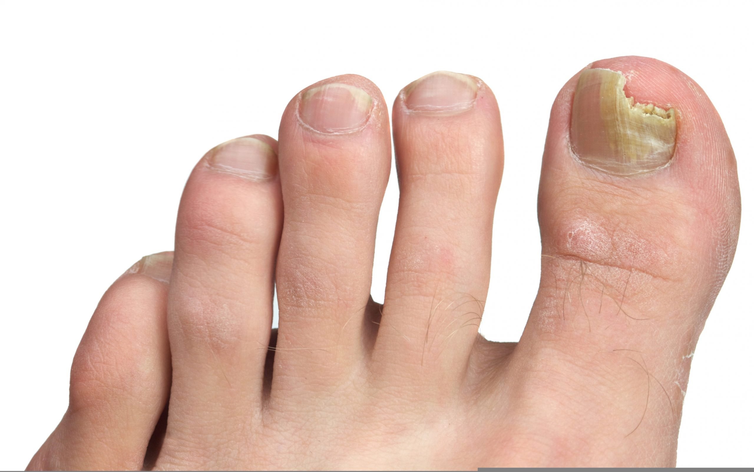 Nail Fungus an infection to be treated