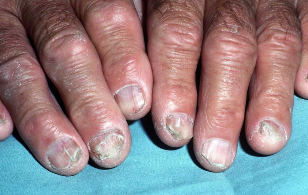 Nail fungus infection, causes and how to get rid of nail ...