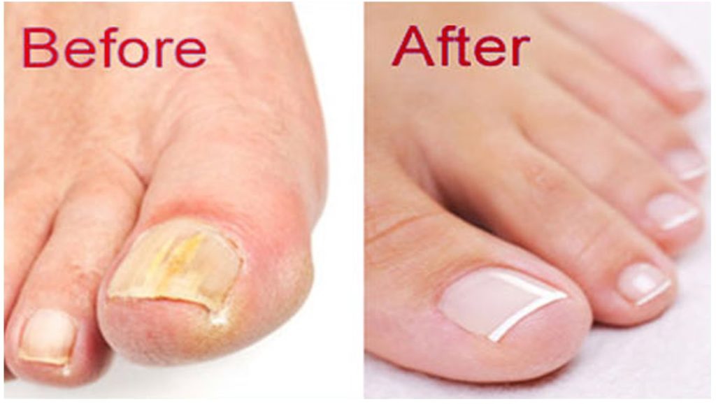 Nail Fungus Nightmares Cured!  Apex Urgent Care Clinic  Walk