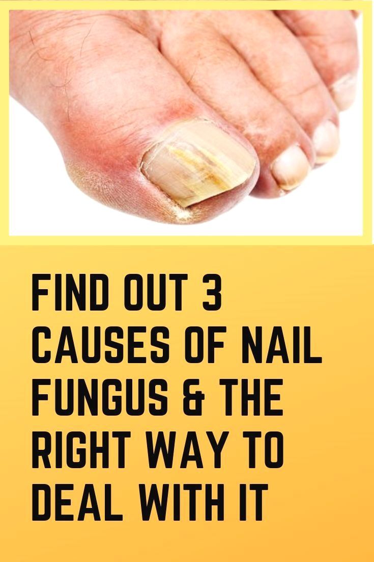 Nail fungus or medically called onychomycosis can be ...
