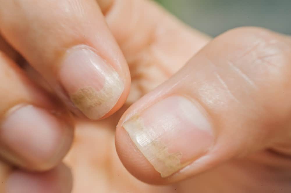Nail Fungus Treatment, Causes &  Symptoms